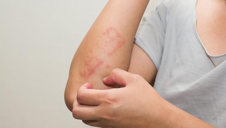bolovi u zglobovima s kožnim osipom kako ublažiti bolove u zglobovima s gripom