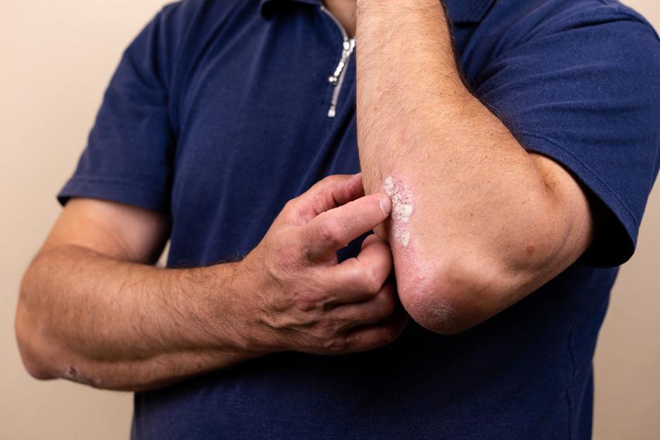 osloboditi se bolova u lakat zglobovima artritis artroza giht liječenje