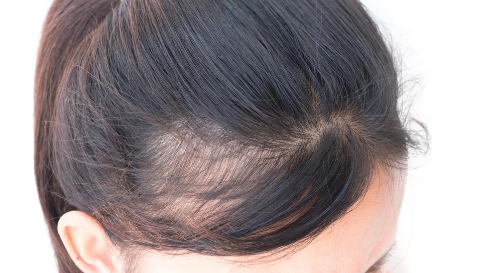 Što je najčešći uzrok ispadanja kose?