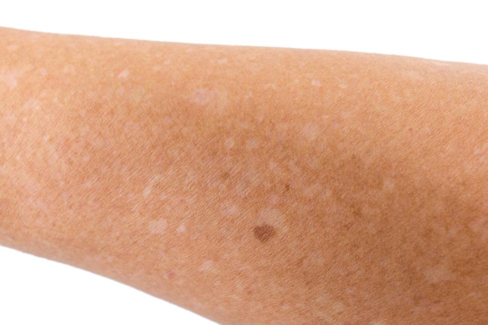Što znače bijele mrljice na mojoj koži i hoće li nestati?