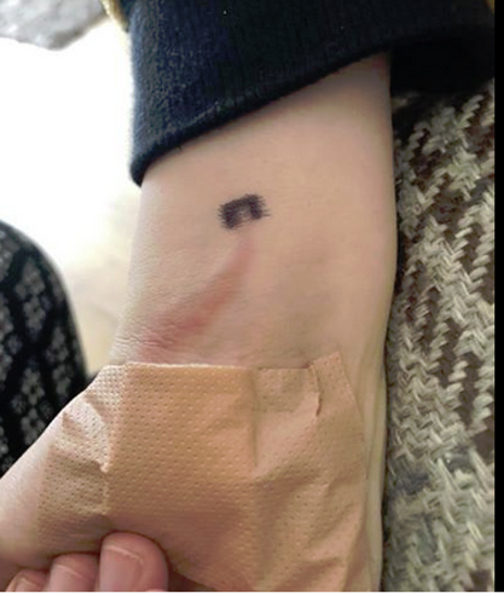 Crvena linija na ruci dječaka bila je upozorenje smrtonosne bolesti