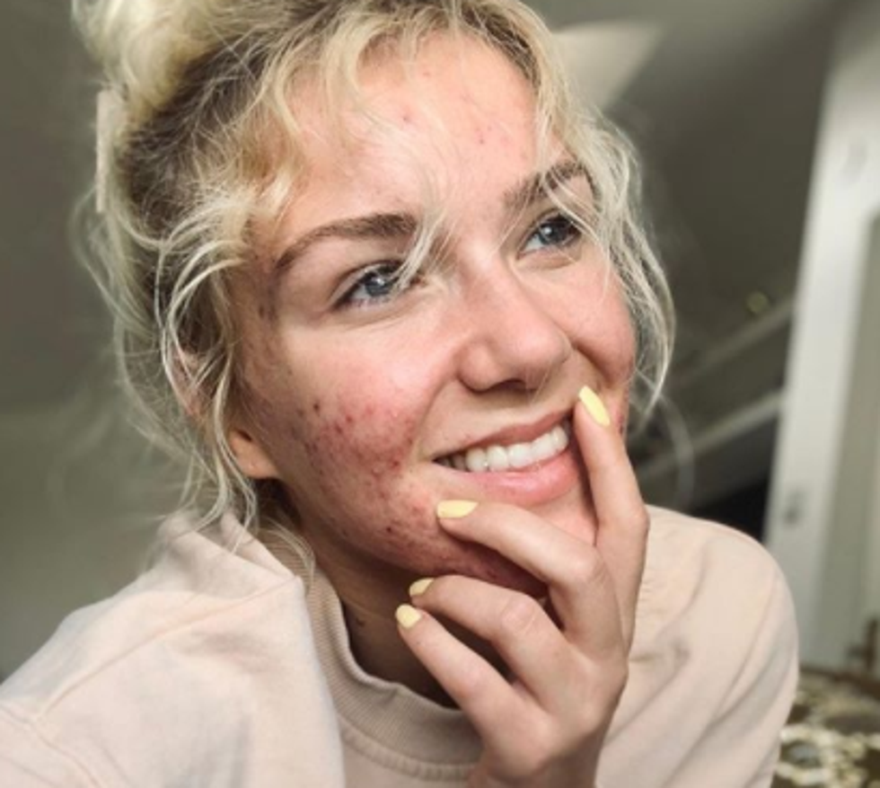 Pjevačica Zsa Zsa pokazala akne i rekla da se zalaže protiv fejk slika na Instagramu