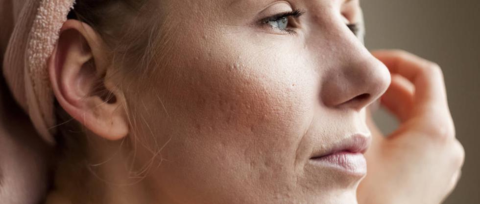 Proširene pore na licu i kako ih učiniti manje vidljivim