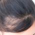 Što je najčešći uzrok ispadanja kose?