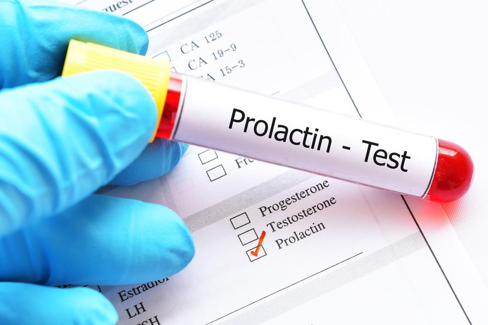 Povišen prolaktin: Najčešći uzroci su tumor hipofize i hipotireoza