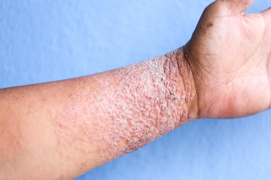 4 prirodna tretmana protiv seboroičnog dermatitisa – Ljekovito bilje