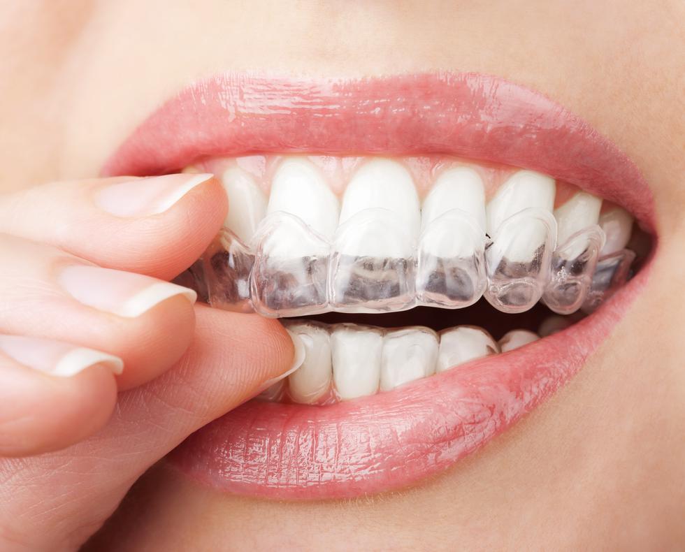 U kojim slučajevima prozirni apartići za korekciju zuba nisu dobar izbor?