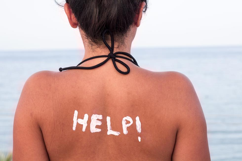 Dermatologinja savjetuje: 5 koraka za samopomoć nakon izgaranja na suncu