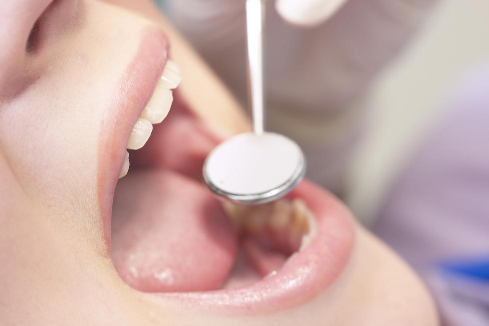 SOS: Kako spasiti zub koji je ispao ili je izbijen?