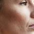 Proširene pore na licu i kako ih učiniti manje vidljivim