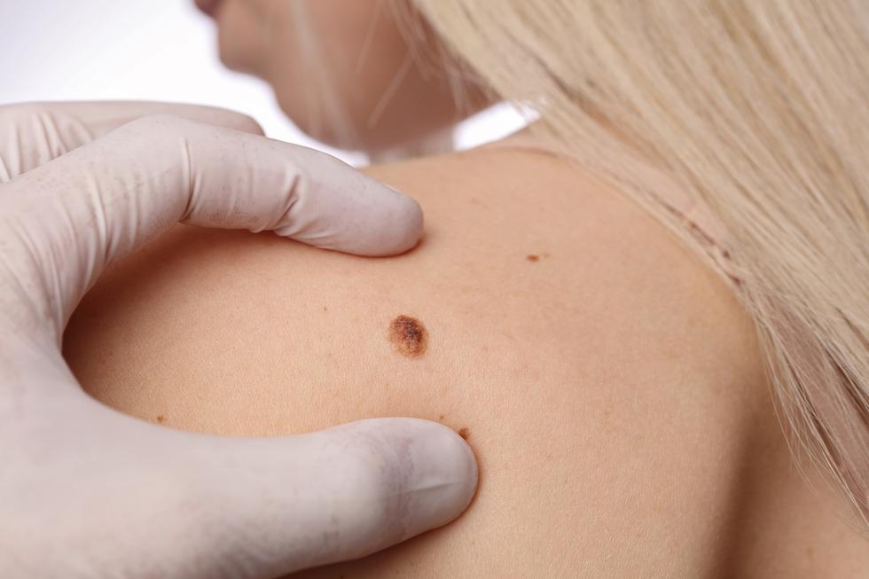 Čak 30 posto melanoma u Hrvatskoj razvije se kod mlađih od 45 godina