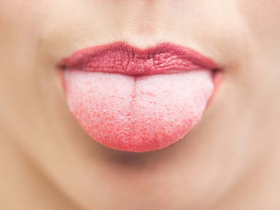 Zašto ti se u ustima stvaraju bijele naslage neugodnog mirisa?