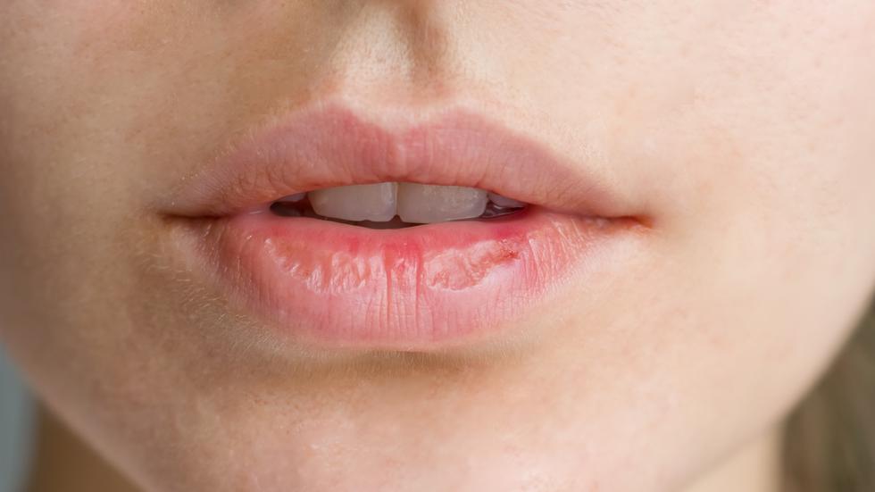 Ispucane usne: Prevencija, njega i kako odabrati kvalitetan proizvod